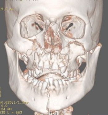 Facial Bone Fracture