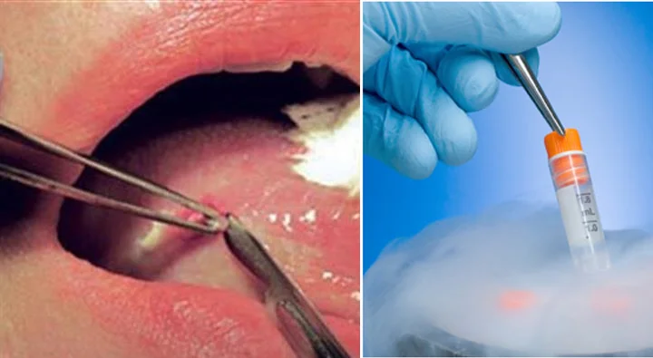 Oral Biopsy